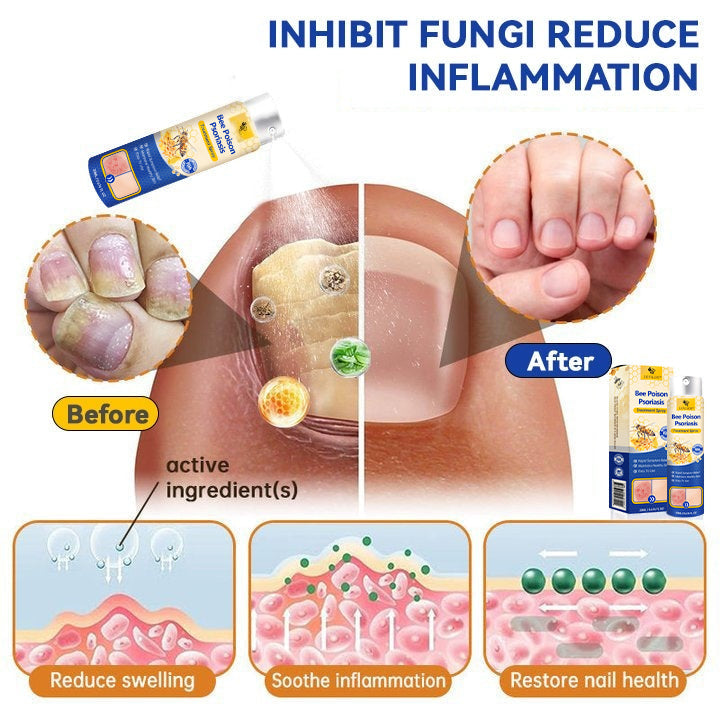 【Official Brand Store】PsoriaHeal Psoriasis Spray Pro