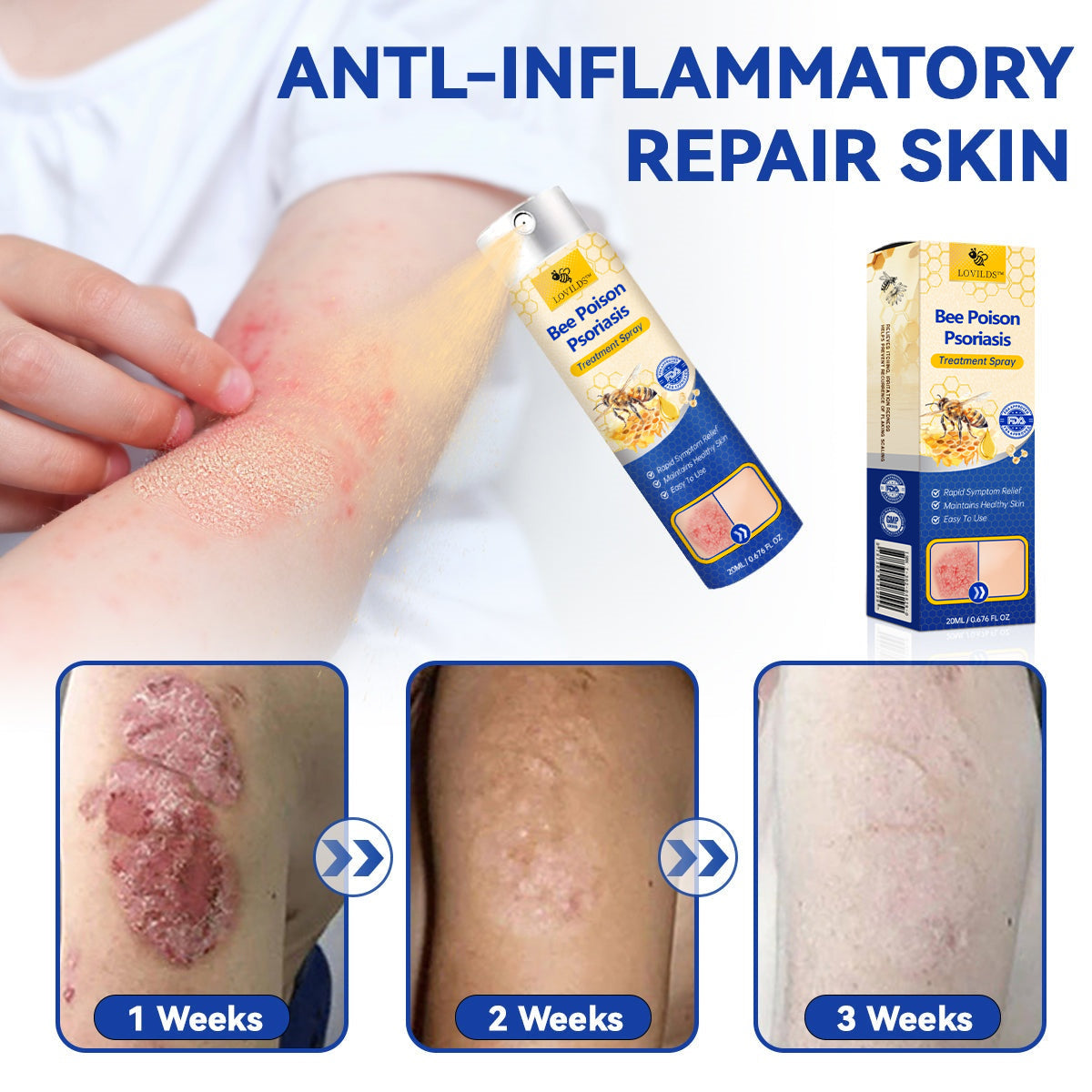 【Official Brand Store】PsoriaHeal Psoriasis Spray Pro