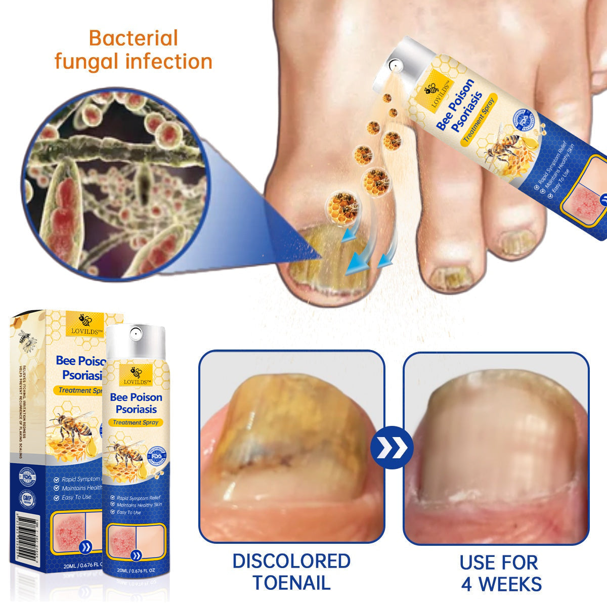 【Official Brand Store】PsoriaHeal Psoriasis Spray Pro