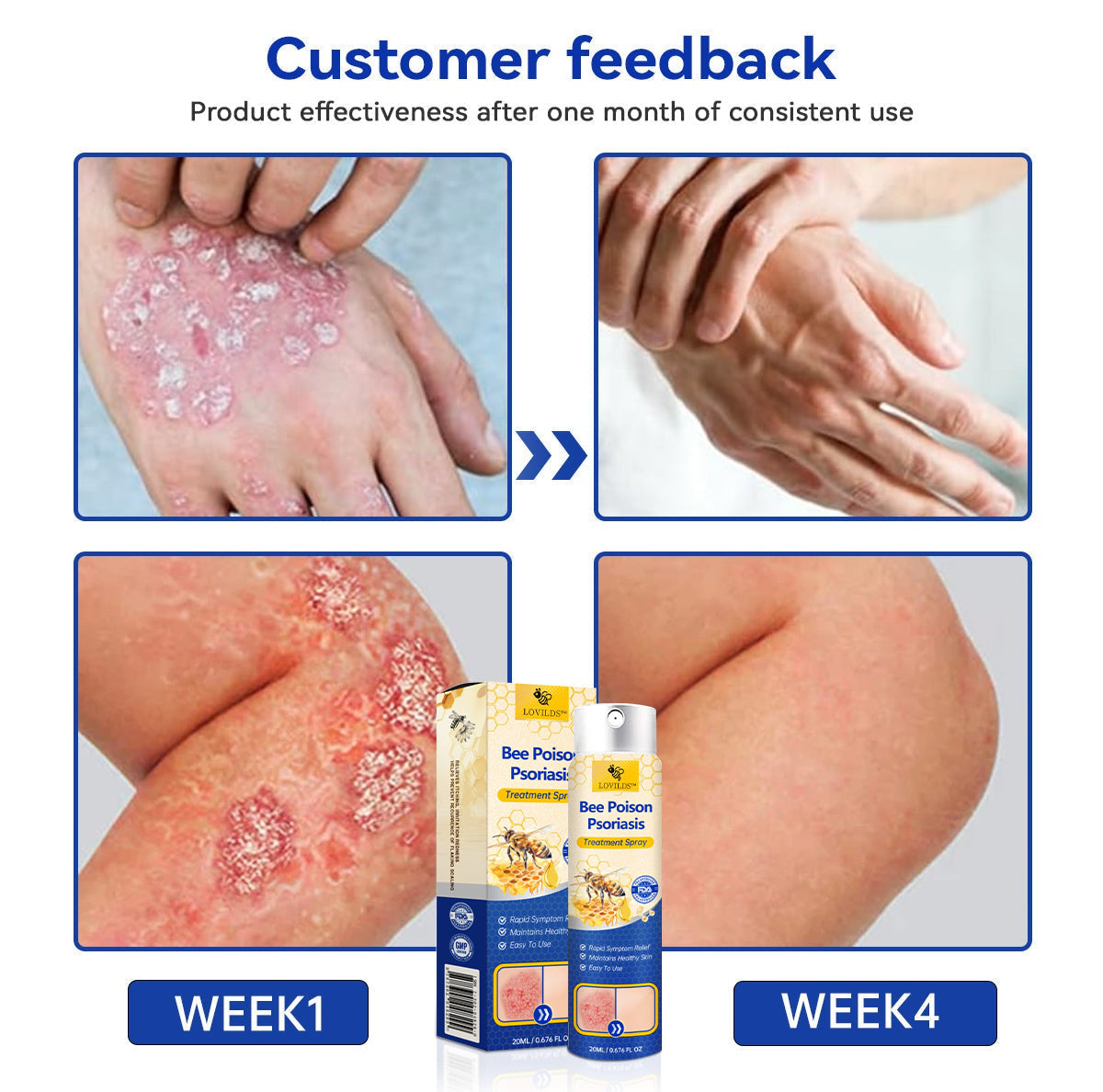 【Official Brand Store】PsoriaHeal Psoriasis Spray Pro