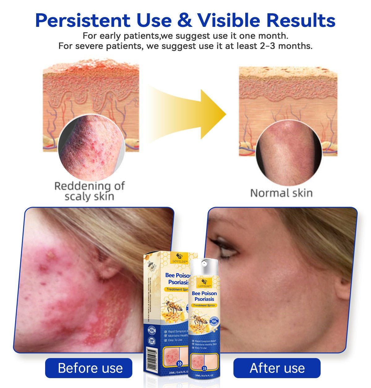 【Official Brand Store】PsoriaHeal Psoriasis Spray Pro