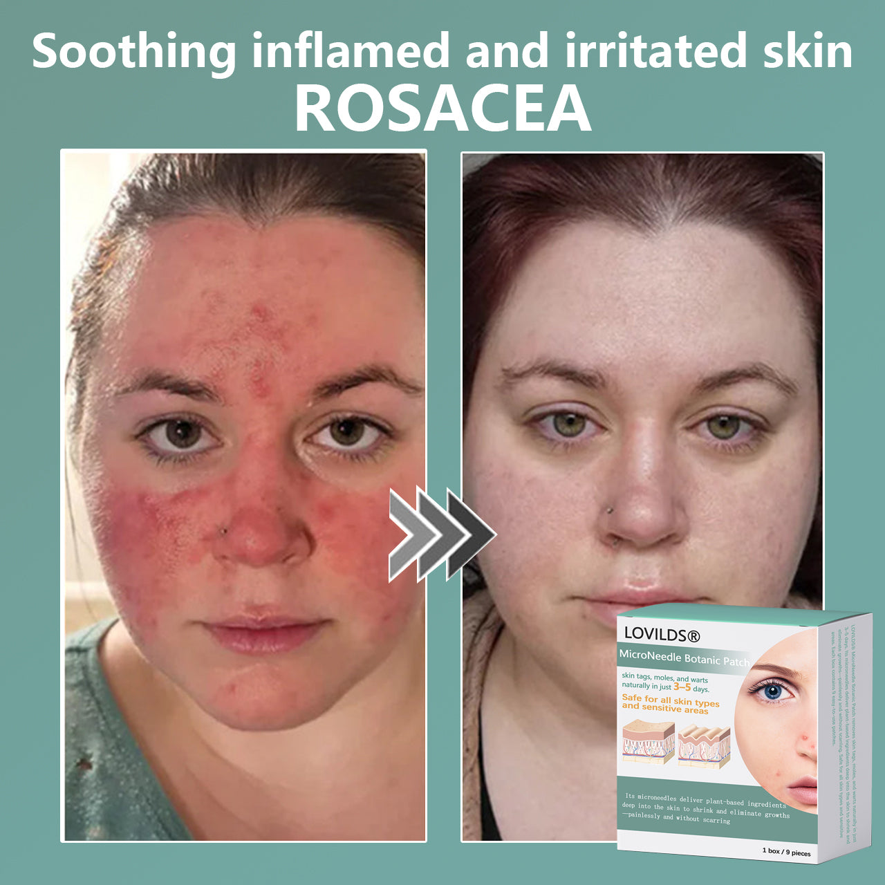 šLOVILDSĀ® MicroNeedle Botanic Skin Tag Removal Patch Made in the USA