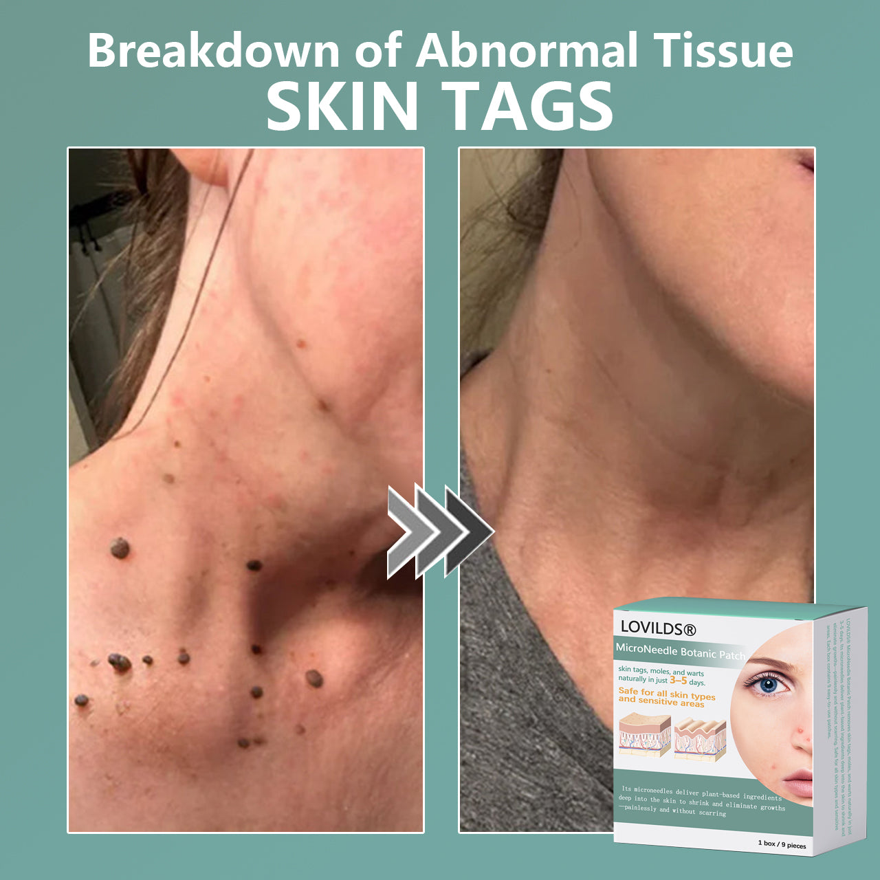 šLOVILDSĀ® MicroNeedle Botanic Skin Tag Removal Patch Made in the USA