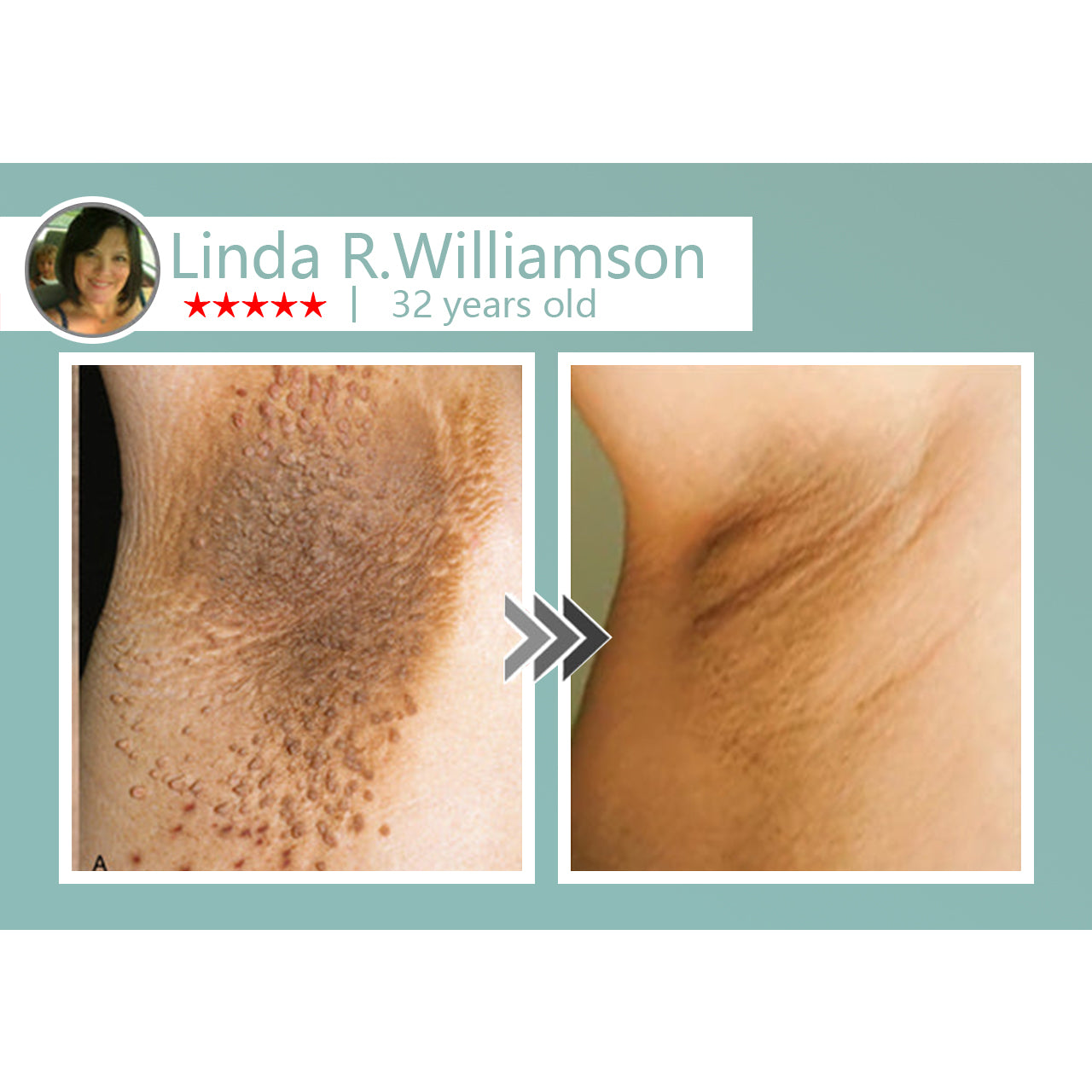 šLOVILDSĀ® MicroNeedle Botanic Skin Tag Removal Patch Made in the USA