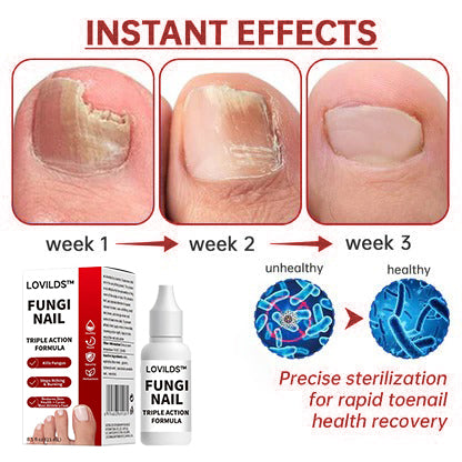 LOVIDS™Powerful toenail fungus treatment, antifungal solution for toenails or fingernails, triple action formula removes fungus, repairs and renews damaged nails