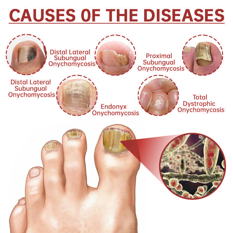 LOVIDS™Powerful toenail fungus treatment, antifungal solution for toenails or fingernails, triple action formula removes fungus, repairs and renews damaged nails