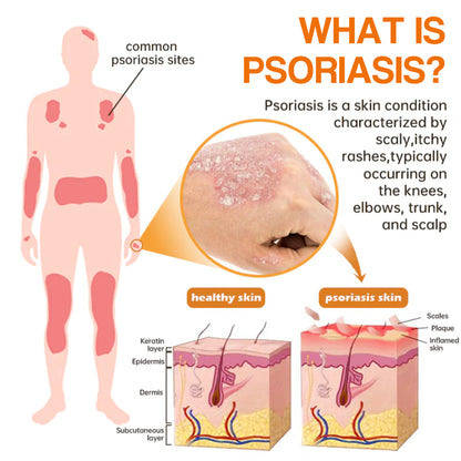 【Official Brand Store】PsoriaHeal Psoriasis Spray Pro