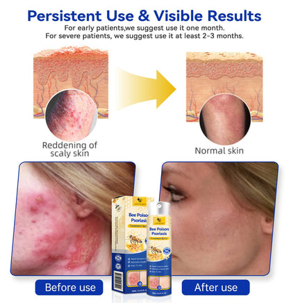 【Official Brand Store】PsoriaHeal Psoriasis Spray Pro