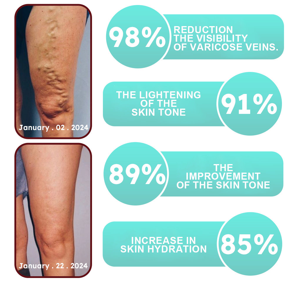 ✨ Last Day Discount: 80% OFF 🌸 LOVILDS™ Leech Varicose Veins Patch