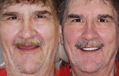 NESLEMY™  Advanced Customized Full Denture Set