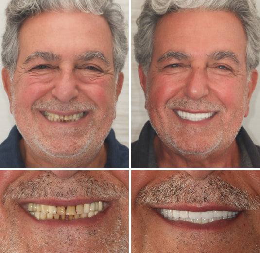 NESLEMY™  Advanced Customized Full Denture Set