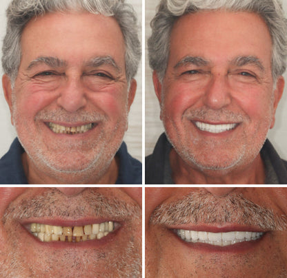 NESLEMY™  Advanced Customized Full Denture Set
