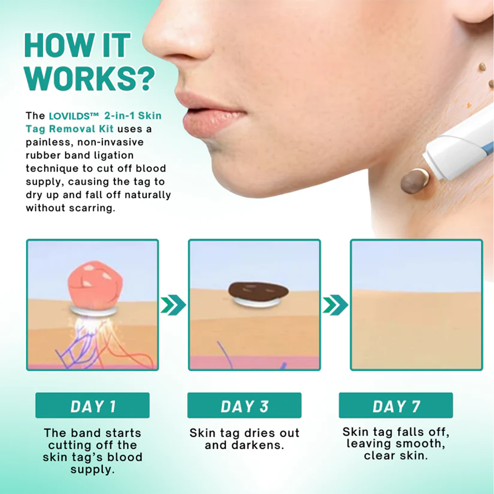 LOVILDS™ 2-in1 Skin Tag Removal Kit