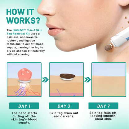 LOVILDS™ 2-in1 Skin Tag Removal Kit