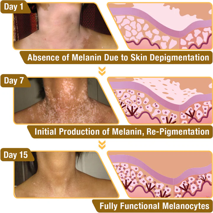 LOVILDS™ Bee Essence Vitiligo Treatment Cream