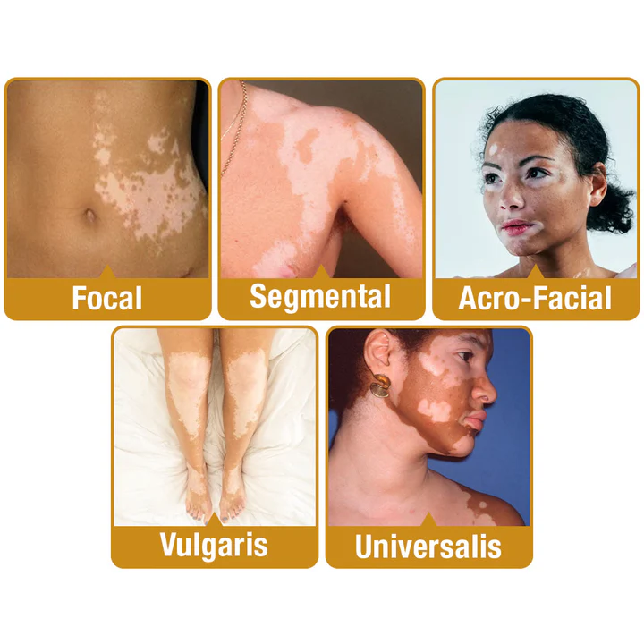 LOVILDS™ Bee Essence Vitiligo Treatment Cream
