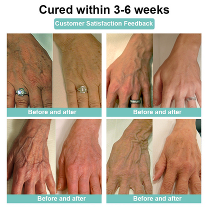 ✨ Last Day Discount: 80% OFF 🌸 LOVILDS™ Leech Varicose Veins Patch