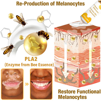 LOVILDS™ Bee Essence Vitiligo Treatment Cream