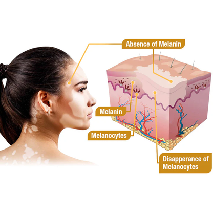 LOVILDS™ Bee Essence Vitiligo Treatment Cream