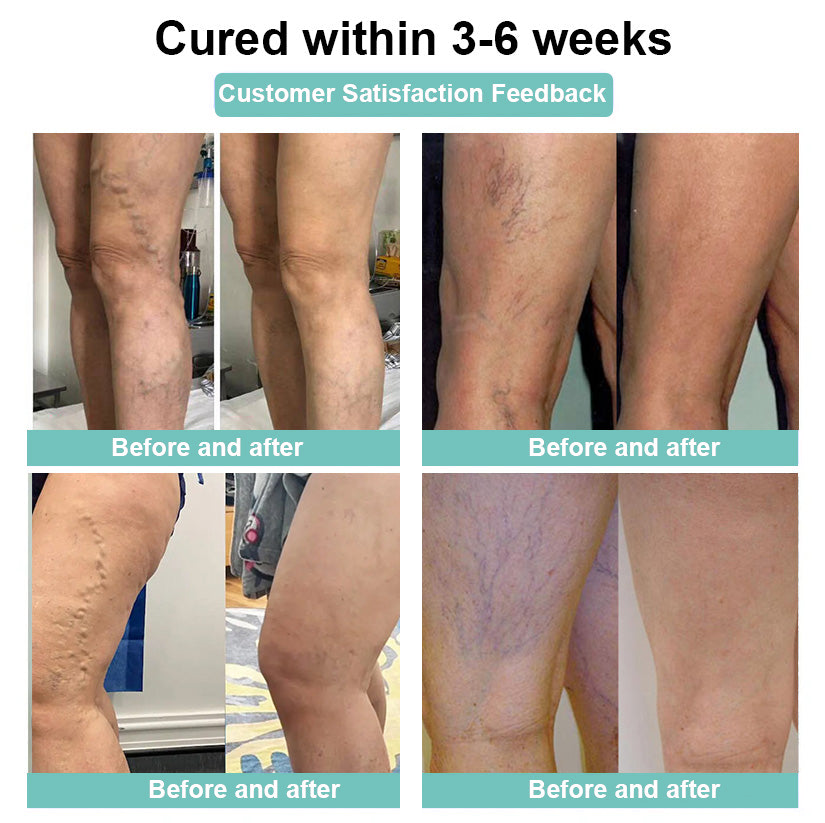 ✨ Last Day Discount: 80% OFF 🌸 LOVILDS™ Leech Varicose Veins Patch