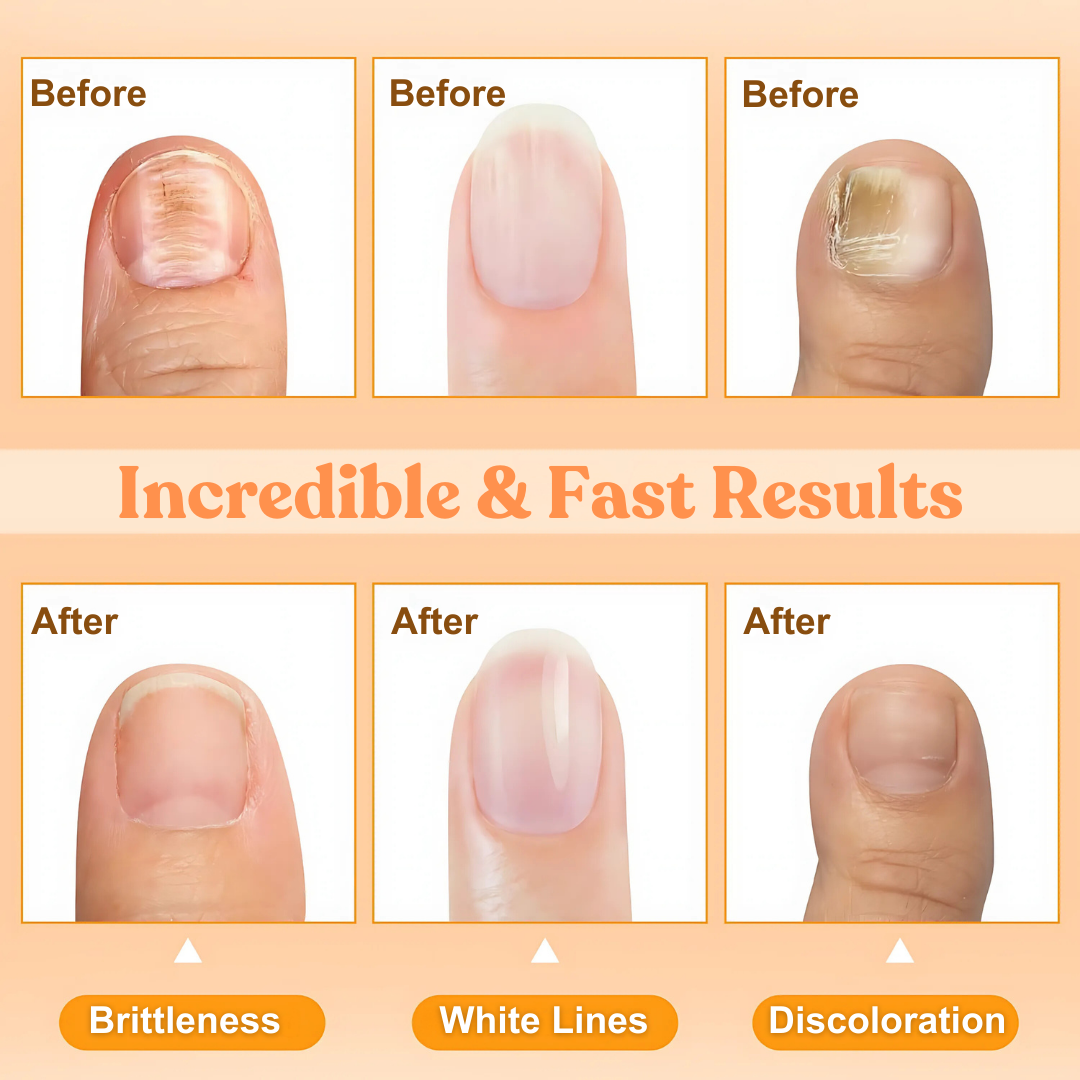 ✅Official Store - Walgreen Pharmacy| LOVILDS™ Bee Poison Nail Repair Treatment Spray