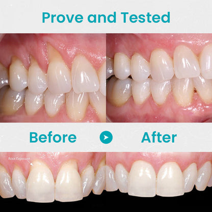 🦷🔥Last Day Promotion 80% OFF-LOVILDS™ Gum Shield Therapy Gel