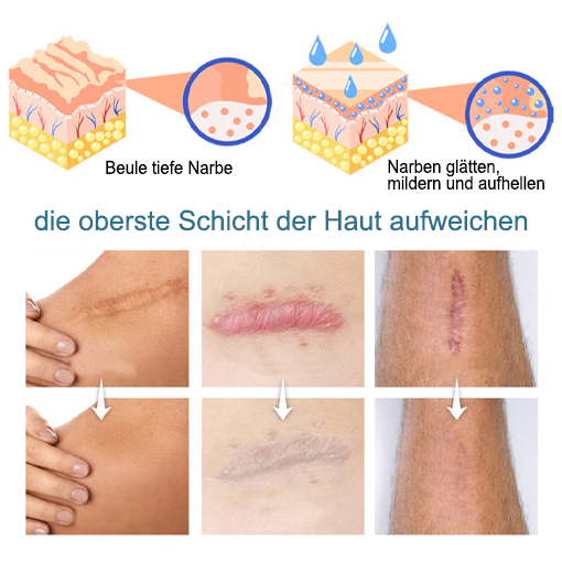 LOVILDS™ Erweiterte Narbenentfernung Gel