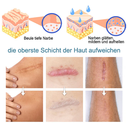 LOVILDS™ Erweiterte Narbenentfernung Gel