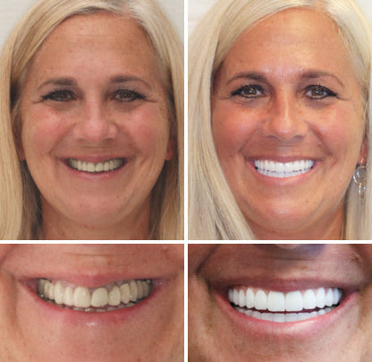 HZA™ --🦷Advanced Customized Full Denture Set🦷 (⏰Limited time discount last 30 minutes⏰)