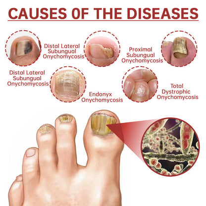 LOVIDS™Powerful toenail fungus treatment, antifungal solution for toenails or fingernails, triple action formula removes fungus, repairs and renews damaged nails