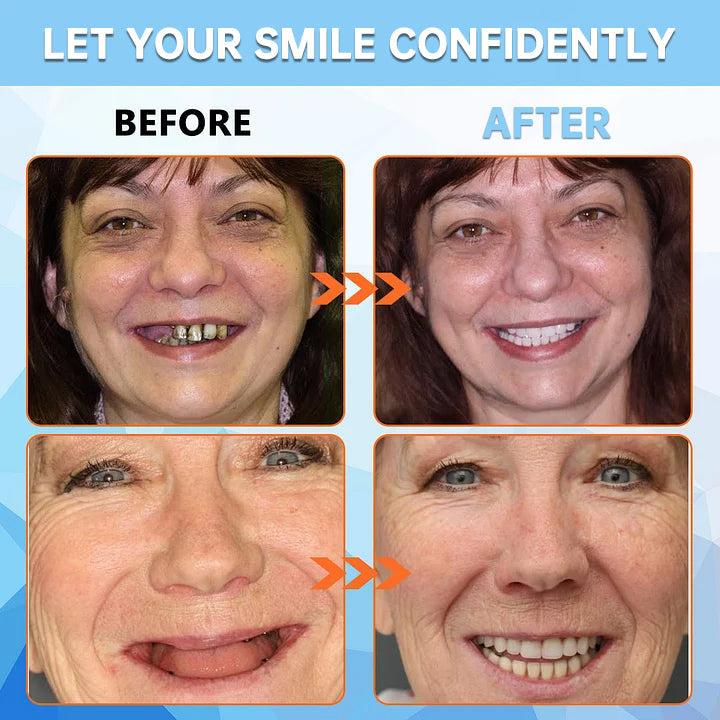 ✅ Official Store: QIAWI™ Adsorptive denture(⏰Limited time discount last 30 minutes⏰)
