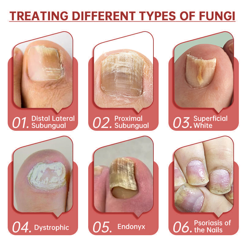 LOVIDS™Powerful toenail fungus treatment, antifungal solution for toenails or fingernails, triple action formula removes fungus, repairs and renews damaged nails