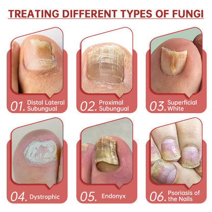LOVIDS™Powerful toenail fungus treatment, antifungal solution for toenails or fingernails, triple action formula removes fungus, repairs and renews damaged nails